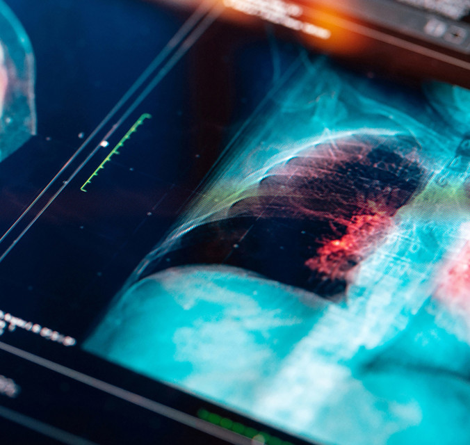 Xray of pair of lungs